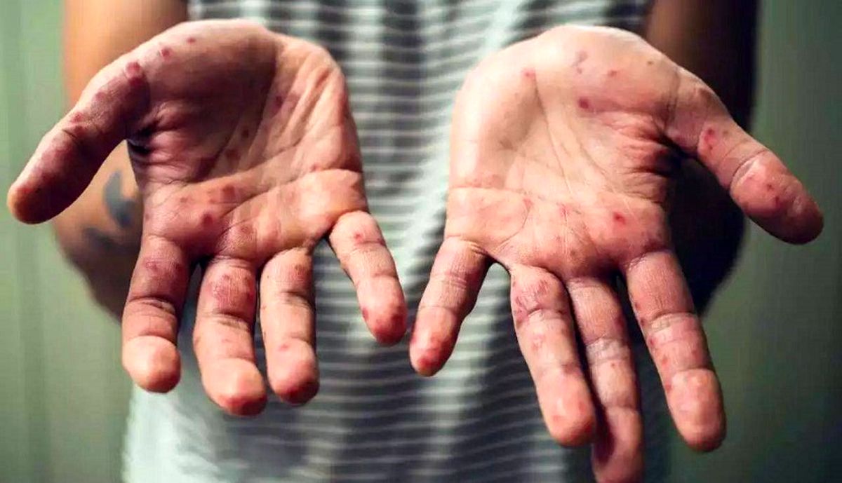 هشدار: آبله میمون در کمین کودکان و نوجوانان | علائم ابتلا به آبله میمون را بشناسید